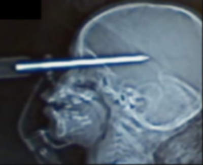 x-ray of foreign object in skull